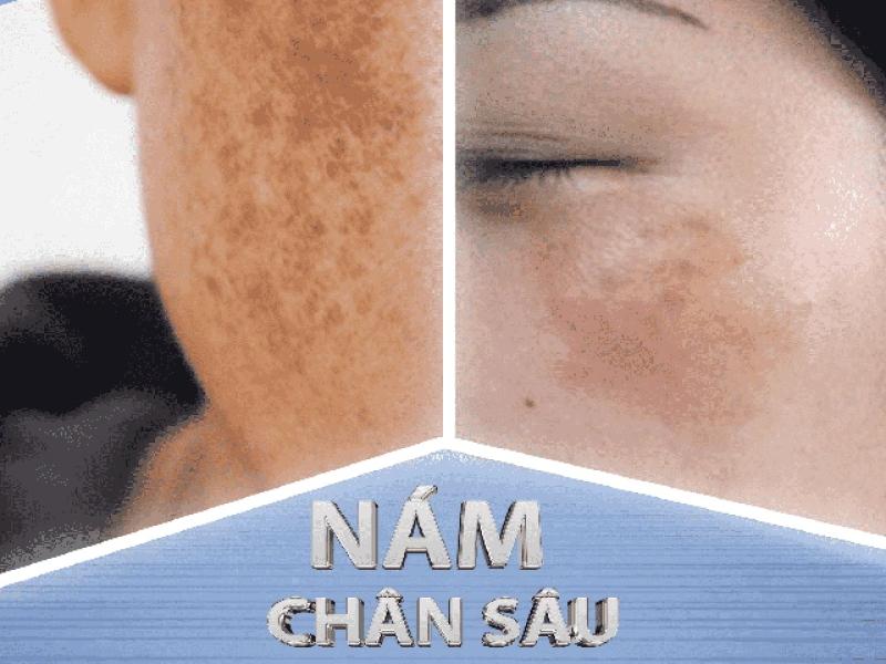 Top 6 kem trị nám chân sâu hiệu quả tại nhà, ngừa tái phát, không bong tróc- Ảnh 1.