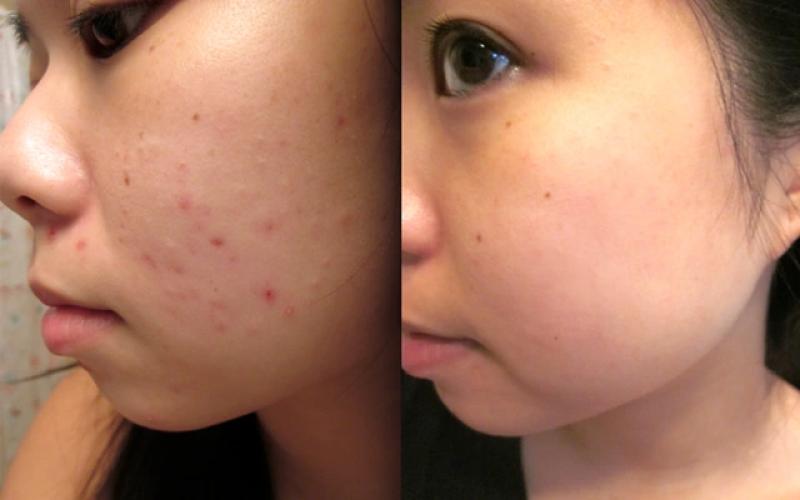 Bật mí cách trị thâm mụn hiệu quả tại nhà, kể cả thâm nặng và lâu năm- Ảnh 2.