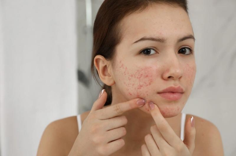 Bật mí cách trị thâm mụn hiệu quả tại nhà, kể cả thâm nặng và lâu năm- Ảnh 3.