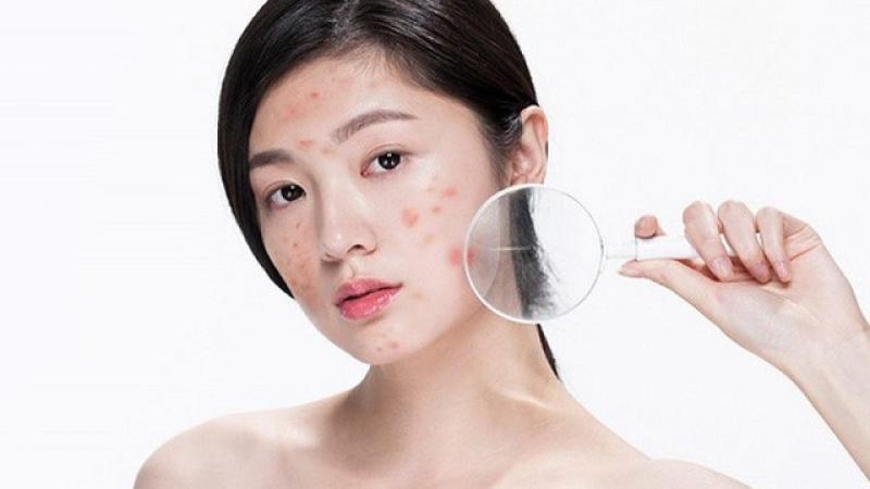 Bật mí cách trị thâm mụn hiệu quả tại nhà, kể cả thâm nặng và lâu năm- Ảnh 4.