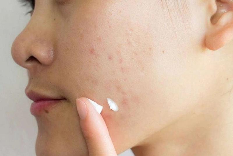 Bật mí cách trị thâm mụn hiệu quả tại nhà, kể cả thâm nặng và lâu năm- Ảnh 5.