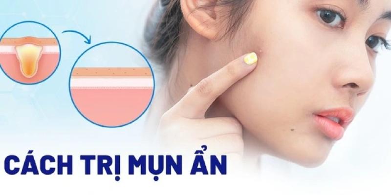 Bật mí cách trị mụn ẩn hiệu quả tại nhà, ngừa tái phát, không để lại sẹo  - Ảnh 1.