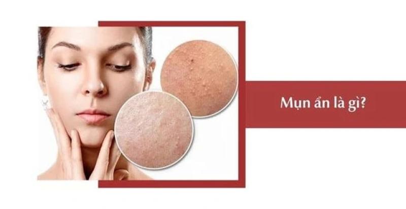 Bật mí cách trị mụn ẩn hiệu quả tại nhà, ngừa tái phát, không để lại sẹo  - Ảnh 2.