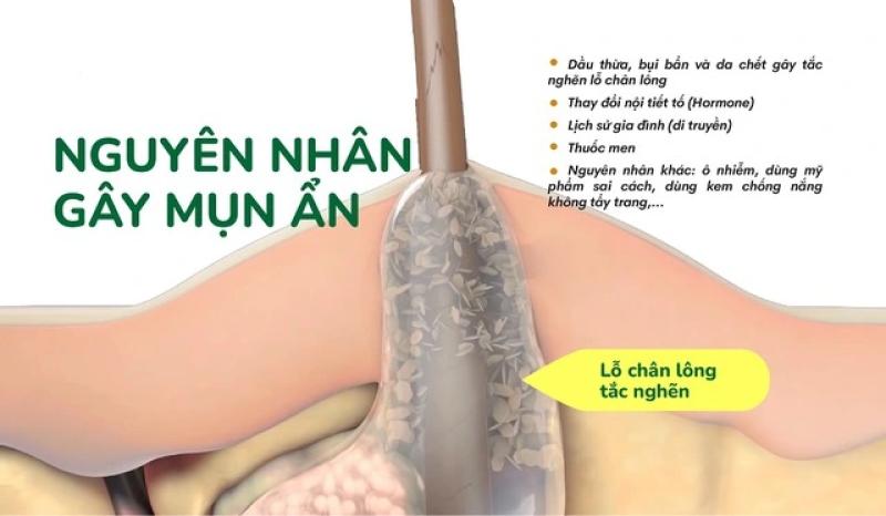 Bật mí cách trị mụn ẩn hiệu quả tại nhà, ngừa tái phát, không để lại sẹo  - Ảnh 3.