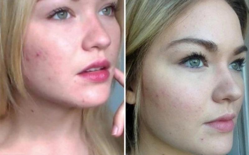 Gợi ý cách trị mụn bọc chuẩn y khoa hiệu quả tại nhà, ngăn ngừa sẹo xấu- Ảnh 1.