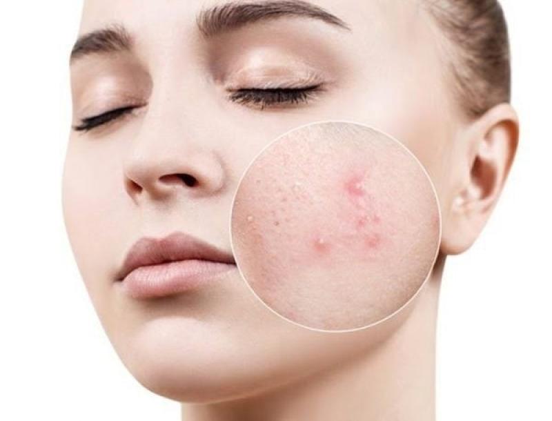 Gợi ý cách trị mụn bọc chuẩn y khoa hiệu quả tại nhà, ngăn ngừa sẹo xấu- Ảnh 2.