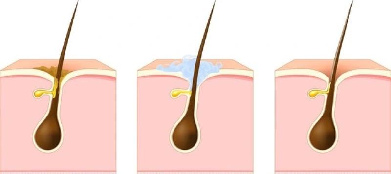 Gợi ý cách trị mụn bọc chuẩn y khoa hiệu quả tại nhà, ngăn ngừa sẹo xấu- Ảnh 3.