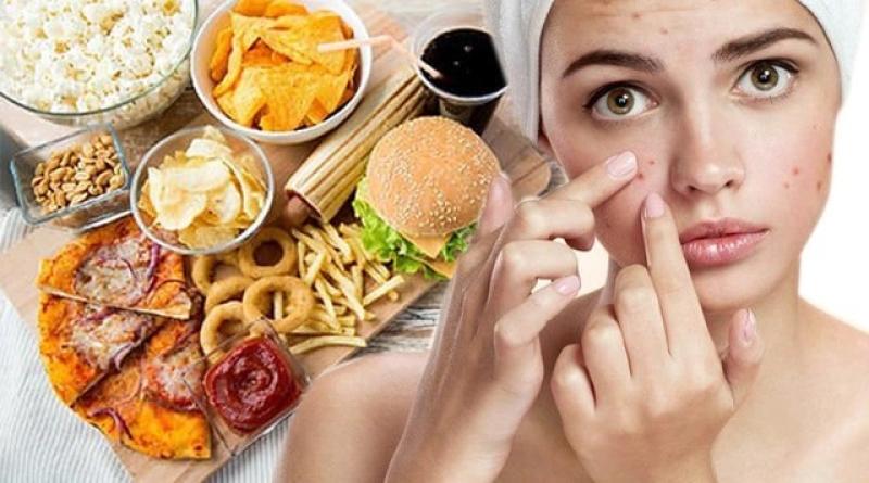 Gợi ý cách trị mụn bọc chuẩn y khoa hiệu quả tại nhà, ngăn ngừa sẹo xấu- Ảnh 4.