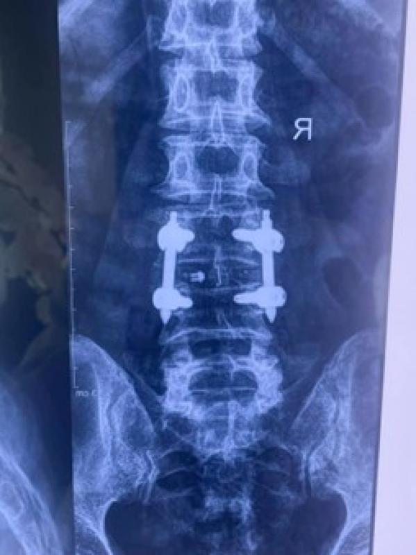 - Ảnh 1. Điều trị thoát vị đĩa đệm bằng nội soi: Cụ ông 74 tuổi phục hồi sau 48 giờ - Ảnh 1.