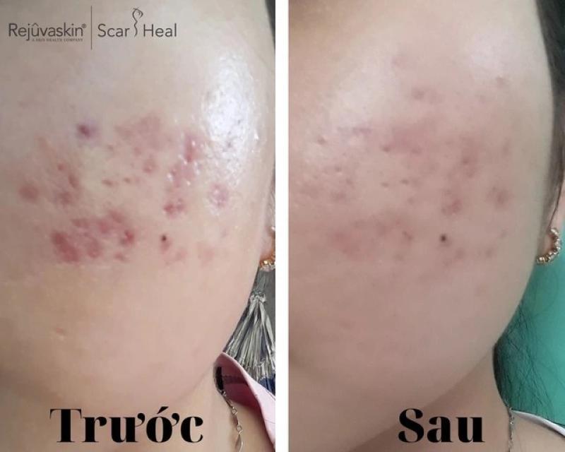 Có cách nào trị thâm sẹo lâu năm hiệu quả tại nhà, tốn ít chi phí?- Ảnh 1.