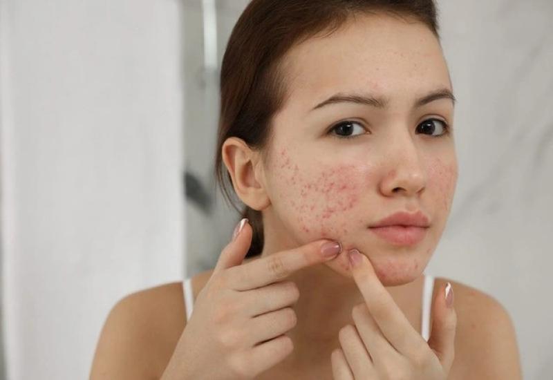 Có cách nào trị thâm sẹo lâu năm hiệu quả tại nhà, tốn ít chi phí?- Ảnh 2.