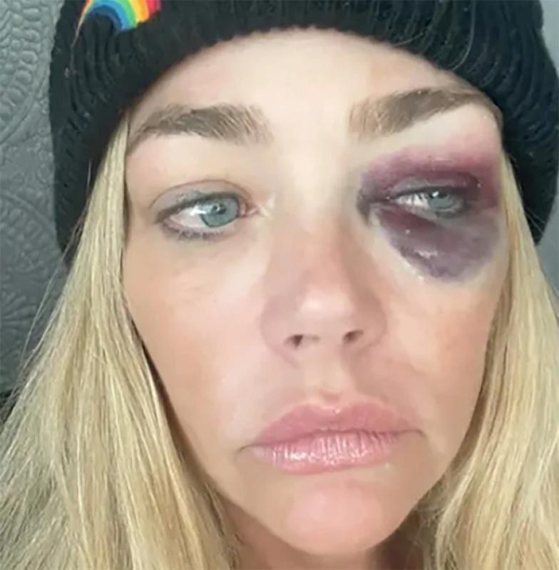 Nữ diễn viên Denise Richards bị chồng bạo hành nặng nề - Ảnh 2.