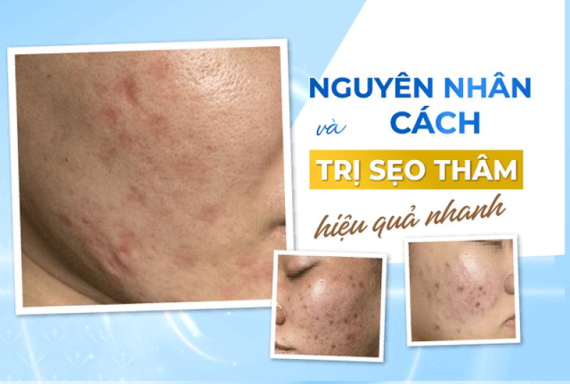 Có cách nào trị thâm sẹo lâu năm hiệu quả tại nhà, tốn ít chi phí?- Ảnh 3.