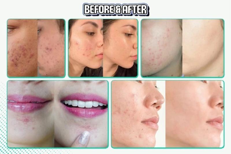 BHA là gì? Vì sao trở thành ngôi sao trong các sản phẩm trị mụn? - Ảnh 8.