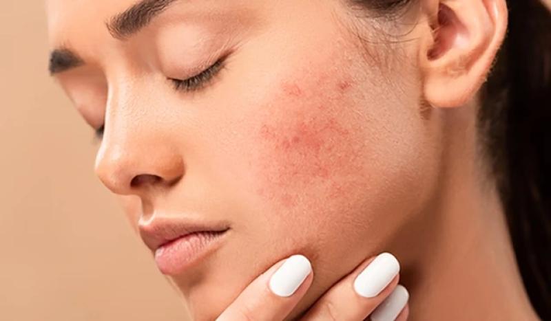 Da kích ứng vì thời tiết - Phục hồi như thế nào?- Ảnh 1.