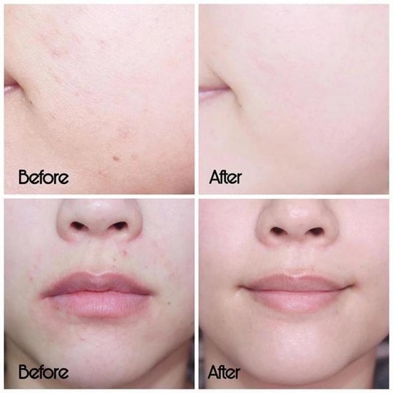 Top 5 kem dưỡng phục hồi sau trị mụn ai cũng 'mê' ngay lần đầu tiên- Ảnh 1.