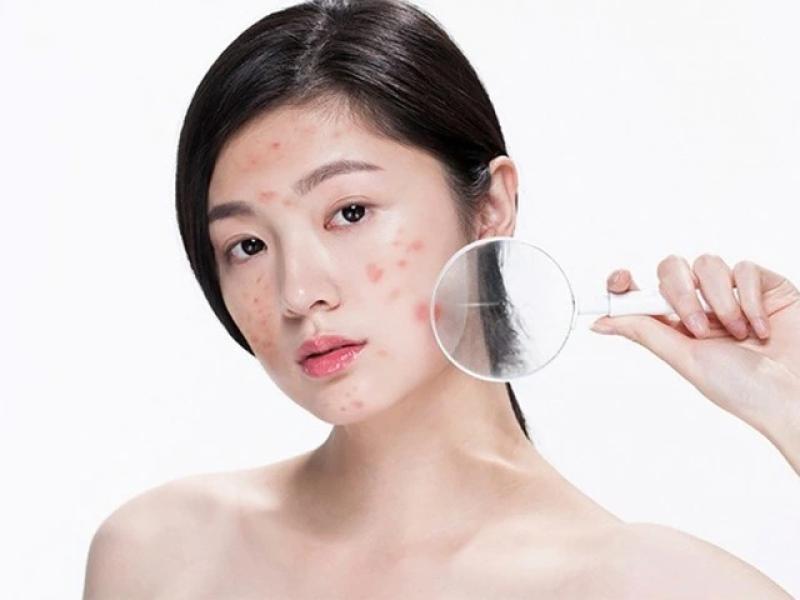Bật mí cách trị thâm sau khi nặn mụn chuẩn y khoa hiệu quả ngay tại nhà- Ảnh 2.