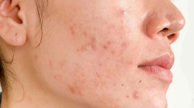 Bật mí cách trị thâm sau khi nặn mụn chuẩn y khoa hiệu quả ngay tại nhà- Ảnh 3.