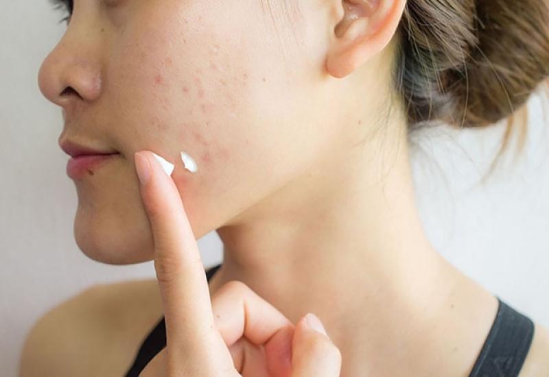 Bật mí cách trị thâm sau khi nặn mụn chuẩn y khoa hiệu quả ngay tại nhà- Ảnh 5.