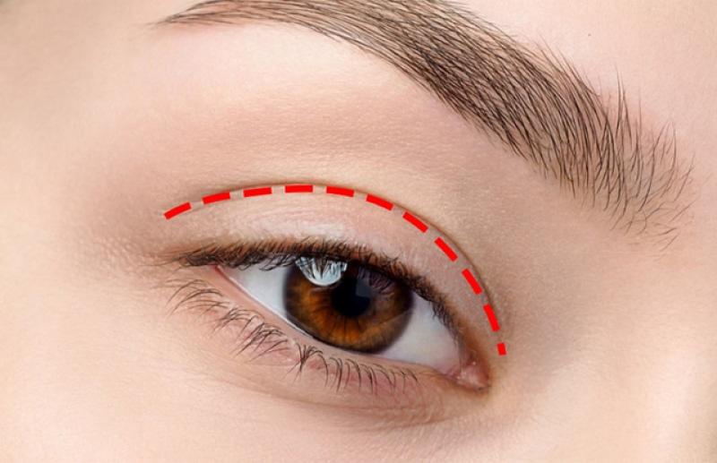 Vết thâm tiểu phẫu không chịu hết? Đây là mẹo chăm chuyên gia hay dùng! - Ảnh 1.