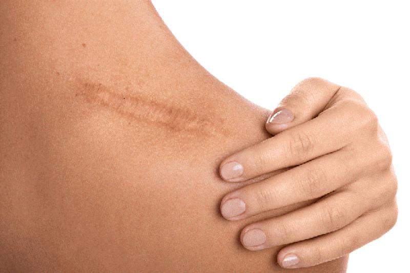Chăm sóc và điều trị sẹo lồi tại nhà bằng các sản phẩm dược mỹ phẩm- Ảnh 2.