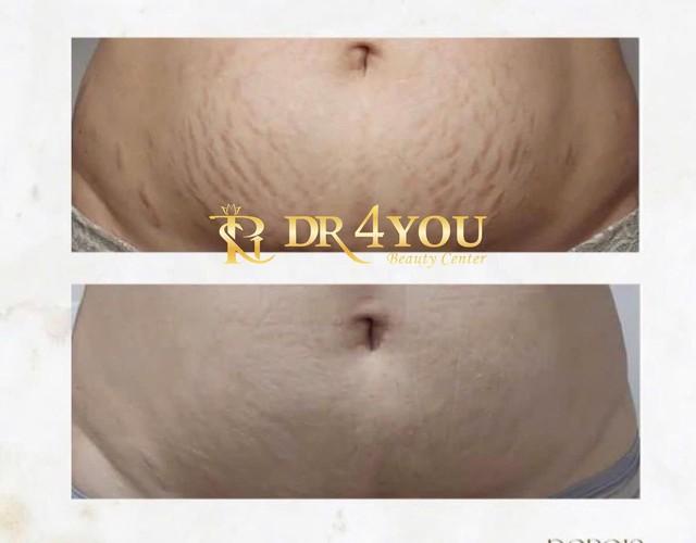 Khám phá 7 lợi ích tuyệt vời của công nghệ Plasma Lạnh trong thẩm mỹ- Ảnh 5. Khám phá 7 lợi ích tuyệt vời của công nghệ Plasma Lạnh trong thẩm mỹ- Ảnh 5.