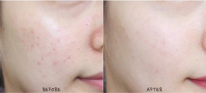 Top 4 sản phẩm trị mụn cấp tốc cho da nhạy cảm, dịu nhẹ không kích ứng - Ảnh 1.