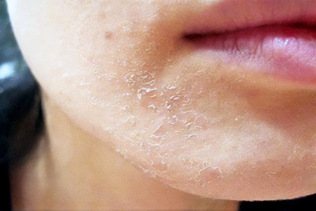 Bỗng một ngày da đỏ rát, bong tróc, phải làm sao?- Ảnh 1.