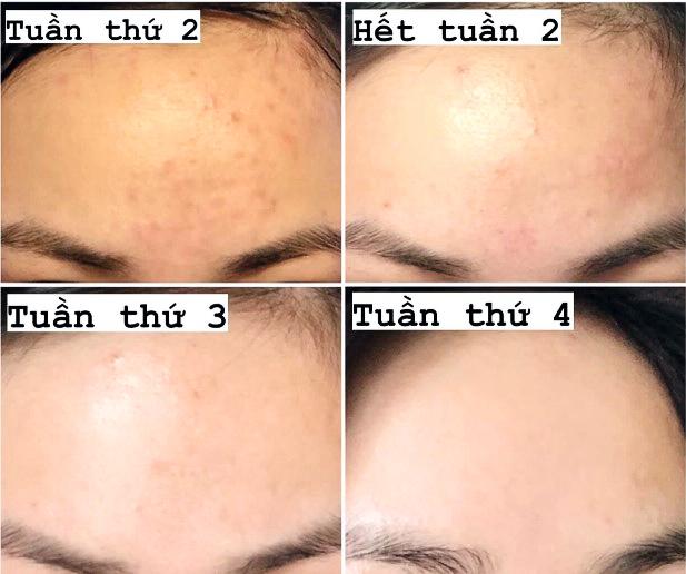[Review] Top 4 kem giảm mụn ẩn hiệu quả, ngừa sẹo tối đa cho da láng mịn- Ảnh 1.