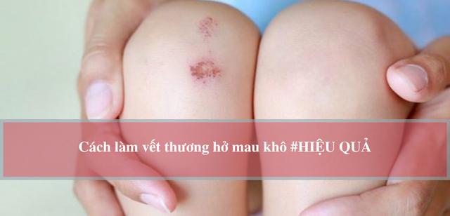 Hướng dẫn cách làm vết thương hở mau khô, nhanh lành và ngừa sẹo ngay tại nhà- Ảnh 1. Hướng dẫn cách làm vết thương hở mau khô, nhanh lành và ngừa sẹo ngay tại nhà- Ảnh 1.
