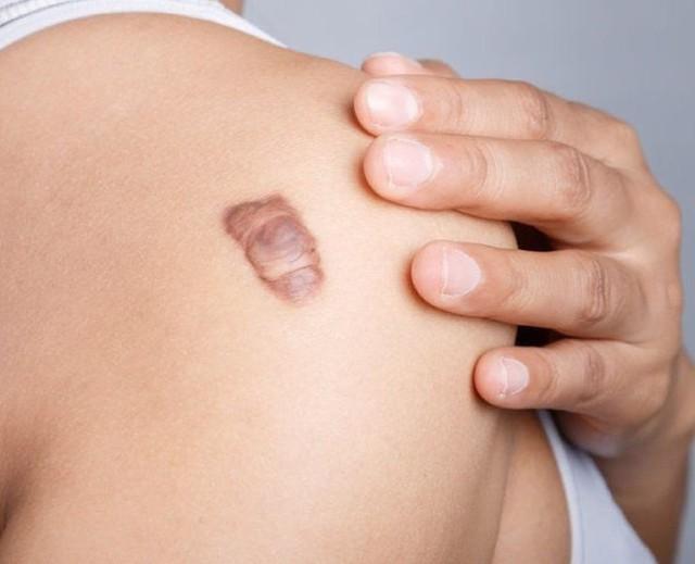 Sẹo lồi: Nguyên nhân và cách điều trị với cả sẹo lâu năm, ngừa tái phát - Ảnh 2.