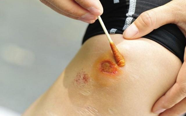 Hướng dẫn cách làm vết thương hở mau khô, nhanh lành và ngừa sẹo ngay tại nhà- Ảnh 2. Hướng dẫn cách làm vết thương hở mau khô, nhanh lành và ngừa sẹo ngay tại nhà- Ảnh 2.