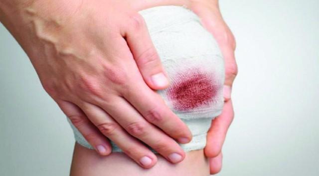 Hướng dẫn cách làm vết thương hở mau khô, nhanh lành và ngừa sẹo ngay tại nhà- Ảnh 3. Hướng dẫn cách làm vết thương hở mau khô, nhanh lành và ngừa sẹo ngay tại nhà- Ảnh 3.