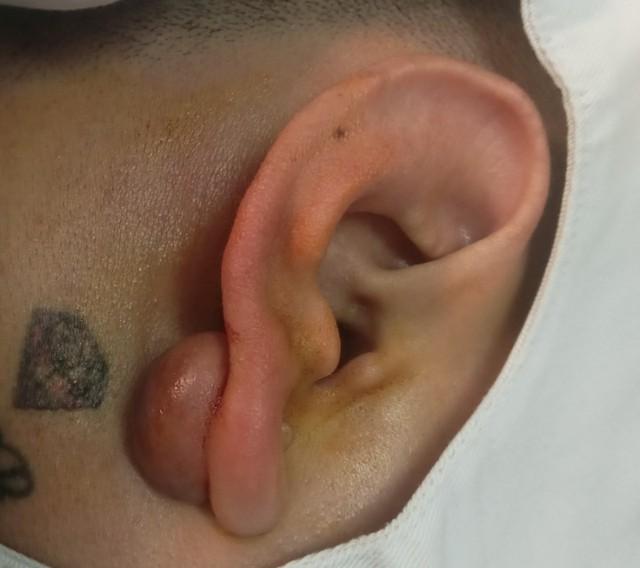 Sẹo lồi: Nguyên nhân và cách điều trị với cả sẹo lâu năm, ngừa tái phát - Ảnh 4.