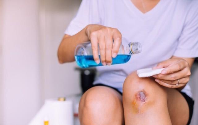 Hướng dẫn cách làm vết thương hở mau khô, nhanh lành và ngừa sẹo ngay tại nhà- Ảnh 4. Hướng dẫn cách làm vết thương hở mau khô, nhanh lành và ngừa sẹo ngay tại nhà- Ảnh 4.