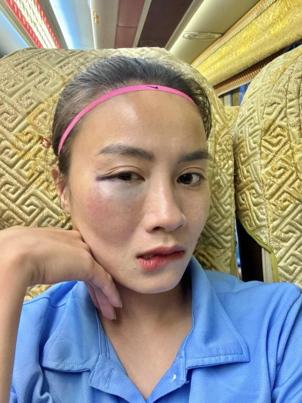 ‘Hot girl’ đội tuyển nữ Việt Nam chia sẻ khuôn mặt bầm tím vì thi đấu, fan xót xa- Ảnh 1.