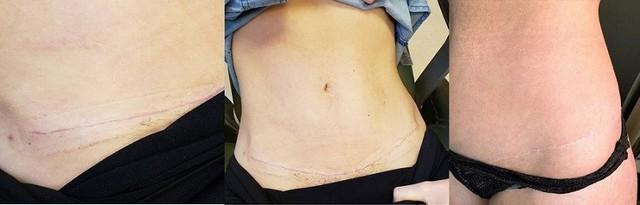 Sẹo lồi: Nguyên nhân và cách điều trị với cả sẹo lâu năm, ngừa tái phát - Ảnh 6.