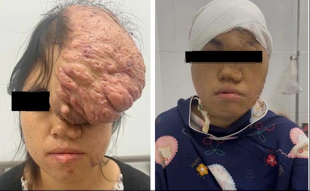 Cô gái Sơn La mang khối u sọ 15 năm được mổ thành công ở Bình Dương - Ảnh 1.