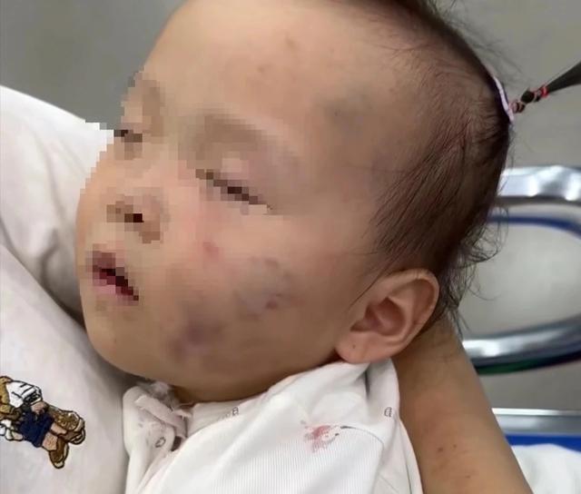 Tạm giữ bảo mẫu vụ bé gái 15 tháng tuổi có nhiều vết bầm tím- Ảnh 1. Tạm giữ bảo mẫu vụ bé gái 15 tháng tuổi có nhiều vết bầm tím- Ảnh 1.