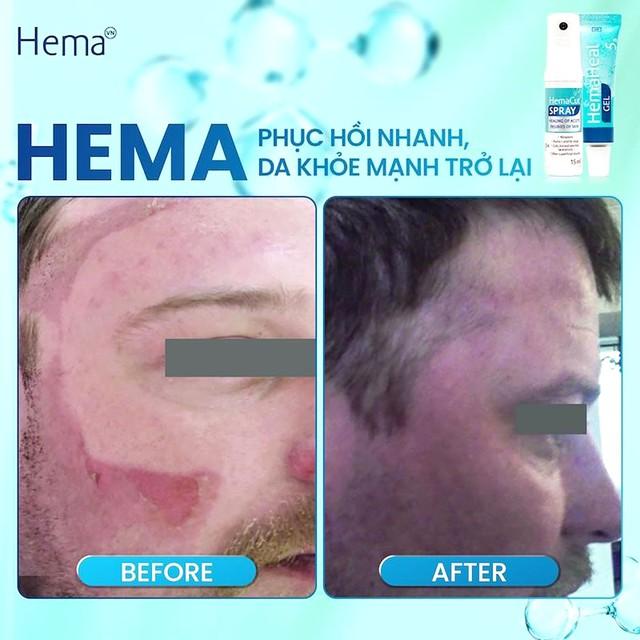 Hema - Tác động sâu vào tiến trình lành thương- Ảnh 4. Hema - Tác động sâu vào tiến trình lành thương- Ảnh 4.