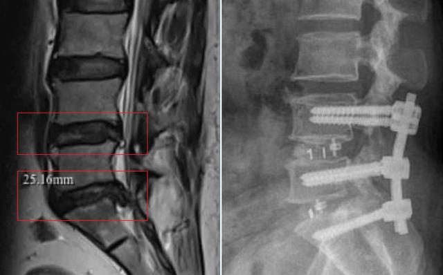 Thoát khỏi đau lưng kinh niên nhờ phẫu thuật TLIF- Ảnh 2. Thoát khỏi đau lưng kinh niên nhờ phẫu thuật TLIF- Ảnh 2.