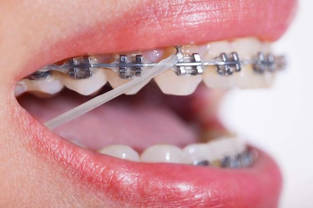 Niềng răng có đau không? Giai đoạn nào đau nhất?- Ảnh 4. Niềng răng có đau không? Giai đoạn nào đau nhất?- Ảnh 4.