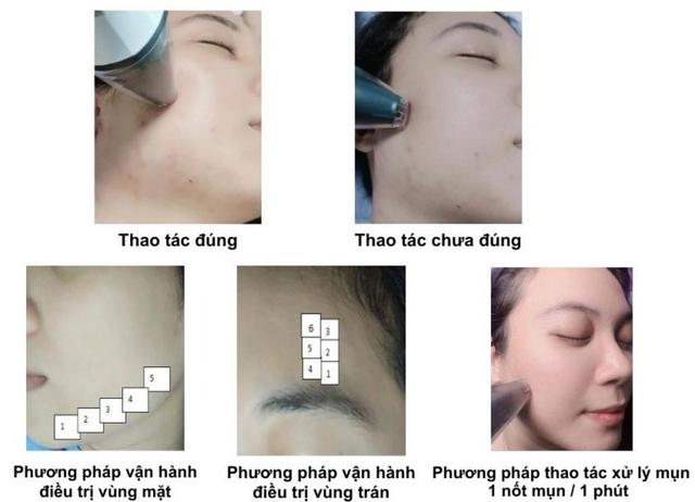 Hướng dẫn sử dụng máy Plasma Gold trong làm đẹp trị sẹo hiệu quả tối ưu - Ảnh 10.
