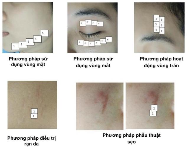 Hướng dẫn sử dụng máy Plasma Gold trong làm đẹp trị sẹo hiệu quả tối ưu - Ảnh 14.