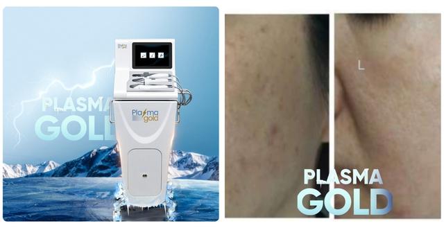 Hướng dẫn sử dụng máy Plasma Gold trong làm đẹp trị sẹo hiệu quả tối ưu - Ảnh 3.