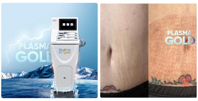 Hướng dẫn sử dụng máy Plasma Gold trong làm đẹp trị sẹo hiệu quả tối ưu - Ảnh 4.