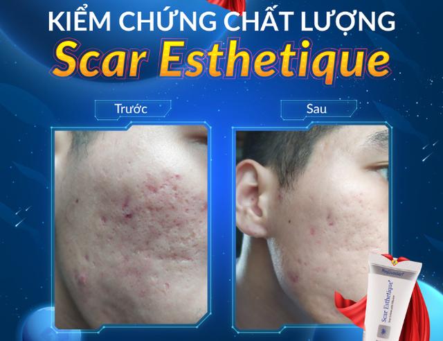 Không laser, không kim: Giải pháp khoa học bôi thoa cho sẹo rỗ mụn - Ảnh 4.