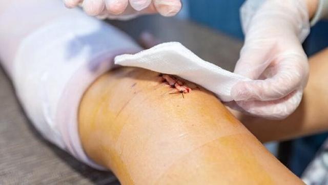 HemaHeal - Thêm một giải pháp ngăn tái nhiễm trùng trong chăm sóc vết thương hiện đại - Ảnh 3. HemaHeal - Thêm một giải pháp ngăn tái nhiễm trùng trong chăm sóc vết thương hiện đại - Ảnh 3.