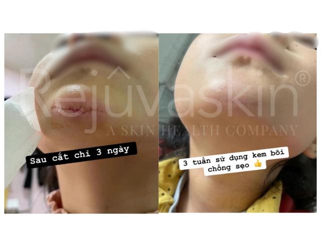 Silicone y tế: Phòng thí nghiệm đến phòng mổ - Hành trình công nghệ kiểm soát sẹo - Ảnh 3.