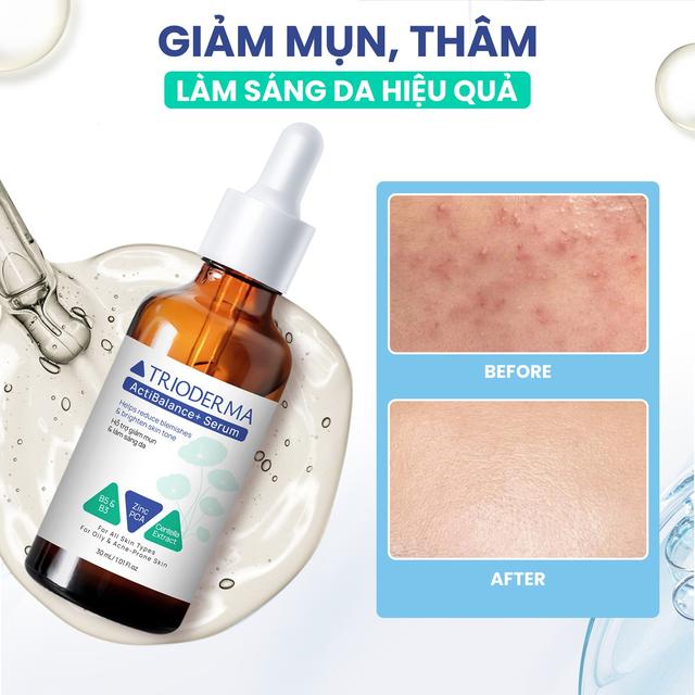 Trioderma gợi ý chu trình chăm sóc da mụn toàn diện, chuẩn y khoa tại nhà - Ảnh 5.